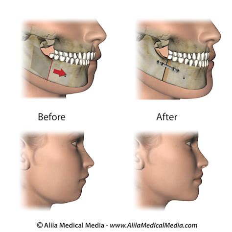 Surgical Orthodontics In Colorado Springs Co Bailey Orthodontics