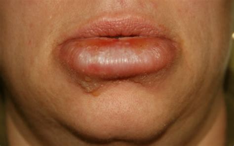 Swollen Lips From The Sun Lipstutorial Org