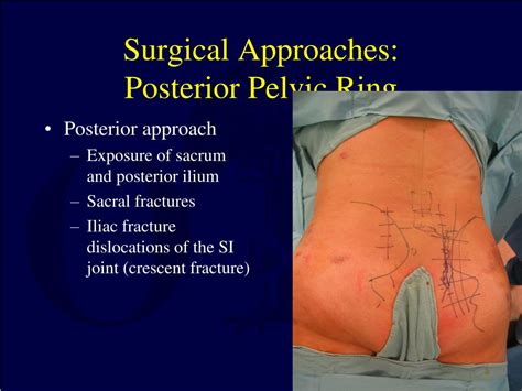 Ppt Pelvic Ring Injuries Definitive Management Powerpoint