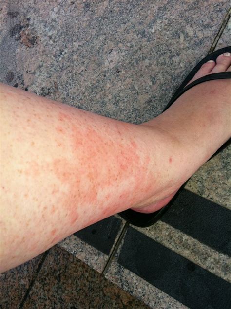 Leg Rashes In Adults Vasculitis Tell The It Because Few Bumps On