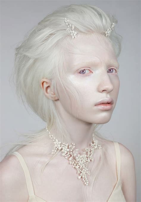 Albinism anomalie genetică ce constă în lipsa totală sau parţială de