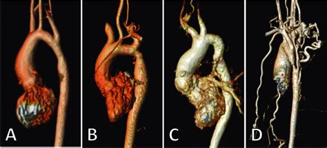 13 Examples Of Aortic Coarctations A Mild Narrowing B Moderate