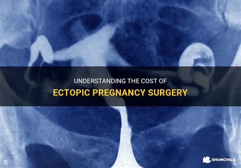 Understanding The Cost Of Ectopic Pregnancy Surgery Shunchild