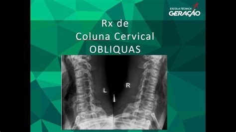 Radiografia Da Coluna Cervical Obliquas Youtube