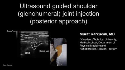 Ultrasound Guided Shoulder Glenohumeral Joint Injection Posterior
