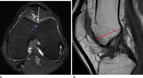MRI Of The Left Knee With Axial Proton Density Weighted Fat Suppressed Download Scientific