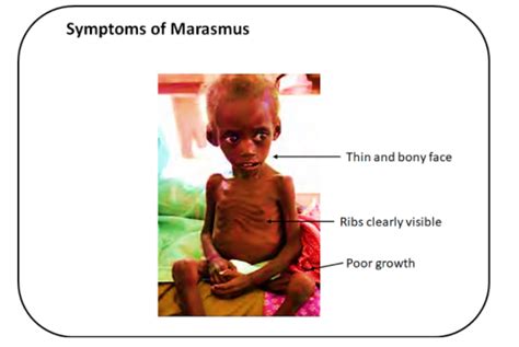 Marasmus Disease Is Caused Due Toaprotein Deficiency Bobesity C