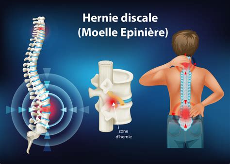 Hernie discale symptômes causes traitements et opération