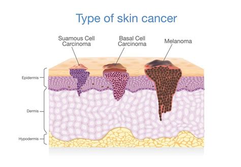 Cancer De La Peau 4 Informations Sur Le Carcinome