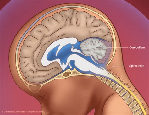 spina bifida treatment midwest fetal care center