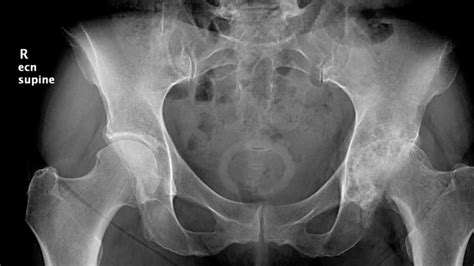 Minimally Invasive Posterior Approach Hip Broadcastmed