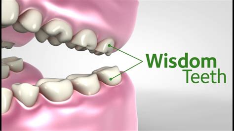 Wisdom Teeth What They Are Possible Complications And Their Treatment