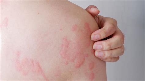 Hives Causes Symptoms And Treatments