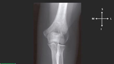 Radiografia Del Codo Frente Y Perfil Fractura De La Porcion Distal Images