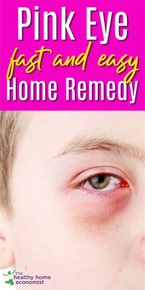 Pinkeye Fast Easy And Best Home Remedy Healthy Home Economist