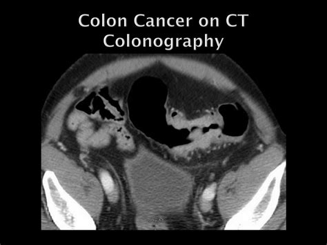 Ppt Imaging Of Colon Cancer Powerpoint Presentation Free Download