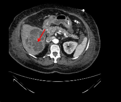 Full Text Successful Percutaneous Drainage Of Large And