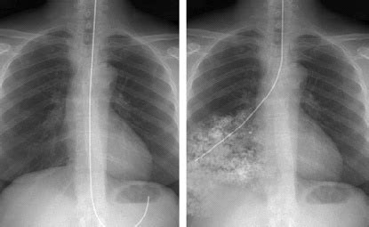 Nasogastric Tube Position On Chest X Ray Summary Radi Vrogue Co