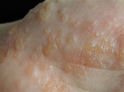 Images Of Eczema Its Sometimes Called The Itch That Rashes Because
