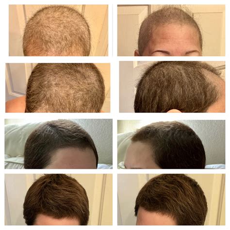 Top 100 Image Hair Growth After Chemo Vn
