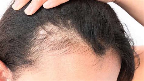 It became very thin and i started losing hair everywhere my hairline still hasnt recovered yet and i doubt it ever will fully recover. Treating Permanent and Temporary Traction Alopecia - Dot ...