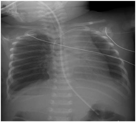 Successful Thoracoscopic Staged Repair Of Bilateral Congenital
