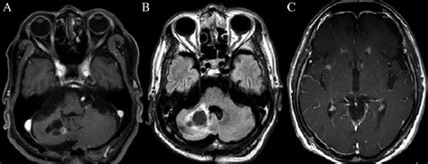 Mri Findings Of Recurrent Lesions A A Gadolinium Enhanced