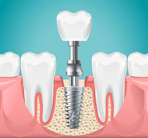 Dental Implants Smile Center Villa Rica