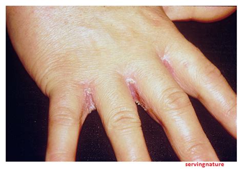 Pictures Of Mens Yeast Infection Pictures Of Thrush On Hands