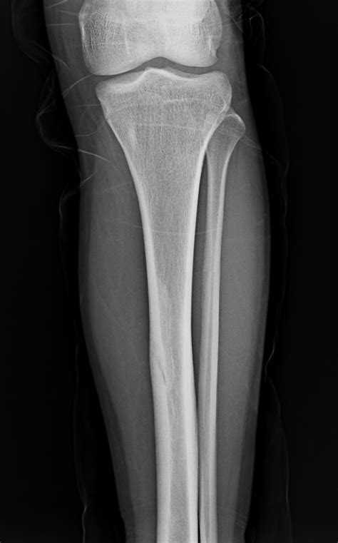 Fractured Tibia X Ray