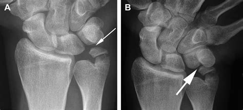 Arthroscopic Management Of Ulnocarpal Impaction Syndrome And Ulnar