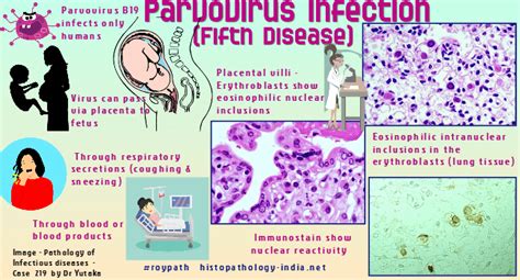 Pathology Of Parvovirus B19 Infection Fifth Disease Dr Sampurna Roy Md