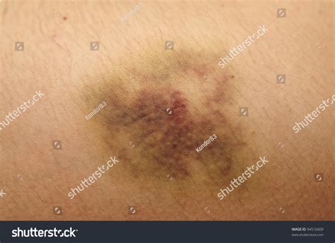 Nasty Looking Bruise On Hip Macro Shot Stock Photo 94516609 Shutterstock
