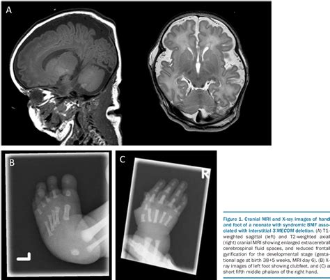 Figure 1 From Lethal Neonatal Bone Marrow Failure Syndrome With