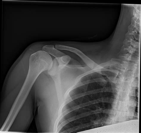 Self improvement, art & photos, technology. A friend of mine tweaked his shoulder climbing. Anything look abnormal? : Radiology