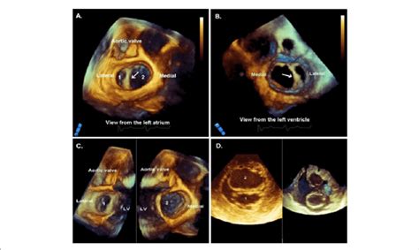 Real Time 3d Transesophageal Echocardiogram En Face View From The