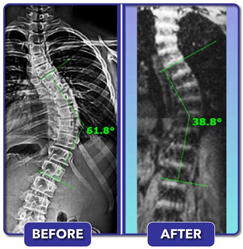 Scoliosis Before And After Treatment Results Scoliosis Care Centers
