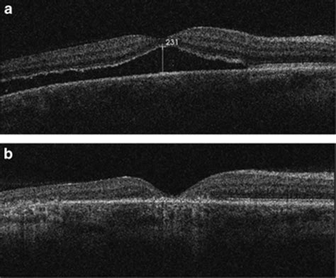 Oct Scans For The Same Patient With Chronic Retinal Detachment