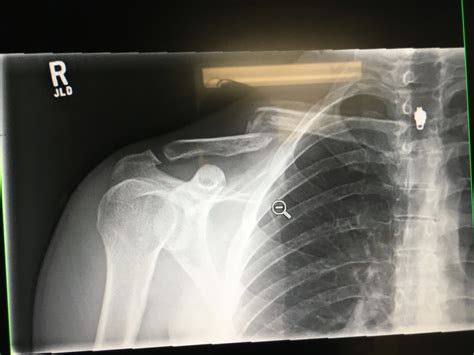 Fractured Clavicle Recovery