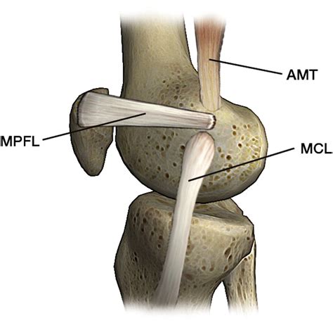 Mri Evaluation And Complications Of Medial Patellofemoral Ligament