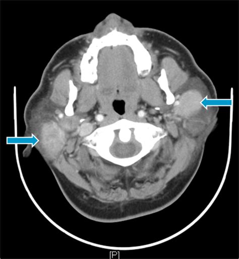 Warthin Tumour A Benign Multifocal Parotid Tumour Eurorad