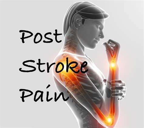 Post Stroke Pain Diagnosis And Treatment Rehab Hq