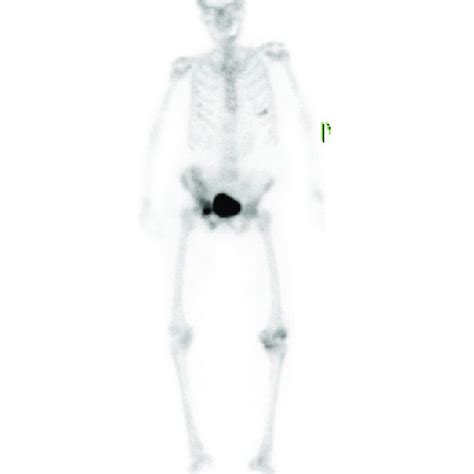 Whole Body Bone Scan After Intravenous Injection Of Tc 99m Hdp