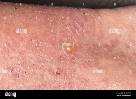 Bullous Pemphigoid Close Up Of A Blister And Dry Flaky Skin On An 80