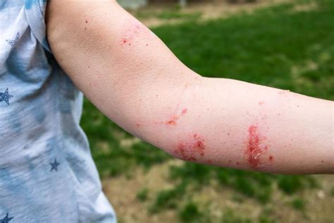 Poison Ivy Oak And Sumac When To Seek Medical Attention