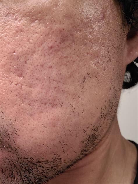 How Can I Treat These Scars Scar Treatments