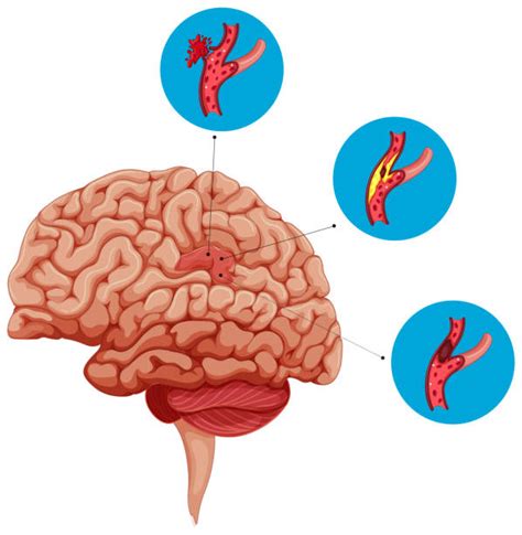 Brain Stroke Graphic Illustrations Royalty Free Vector Graphics And Clip