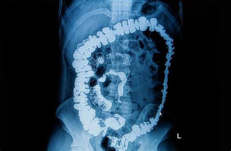 Gastrointestinal Fistula Causes Treatment And Complications