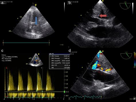 Transthoracic Echocardiogram 4 Chamber View And Transesophageal