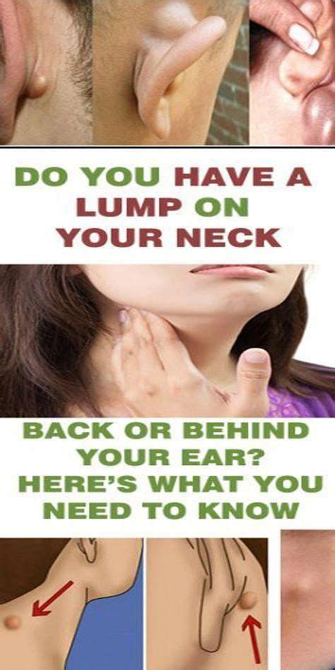 Do You Have Got A Lump On Your Neck Back Or Behind Your Ear This Is